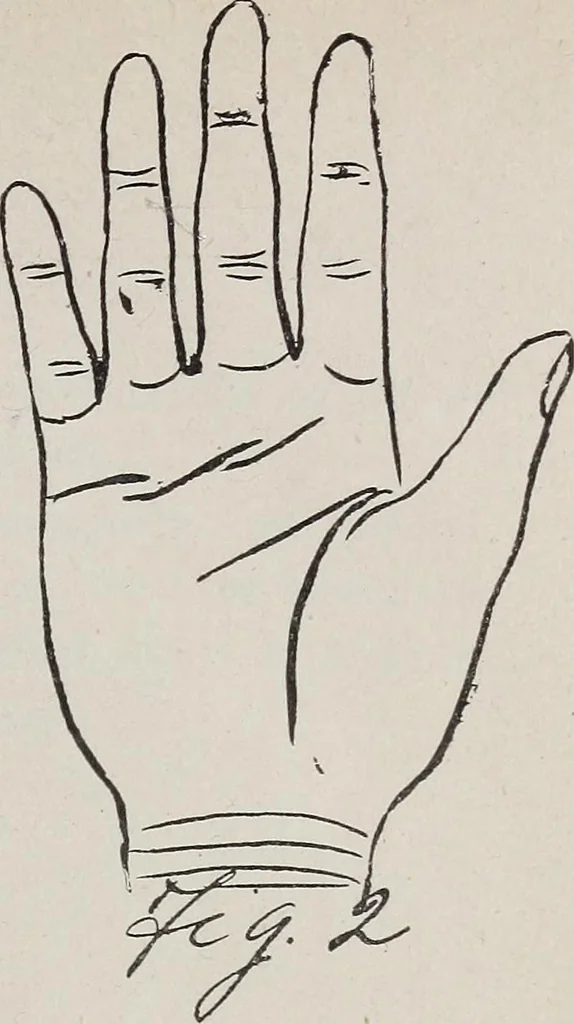 An illustration from Revelations of the hand. A scientific study of the shape and markings of the hand, as an index to character, disease, and tendencies, with explanatory illustrations, 1900, leaf 102