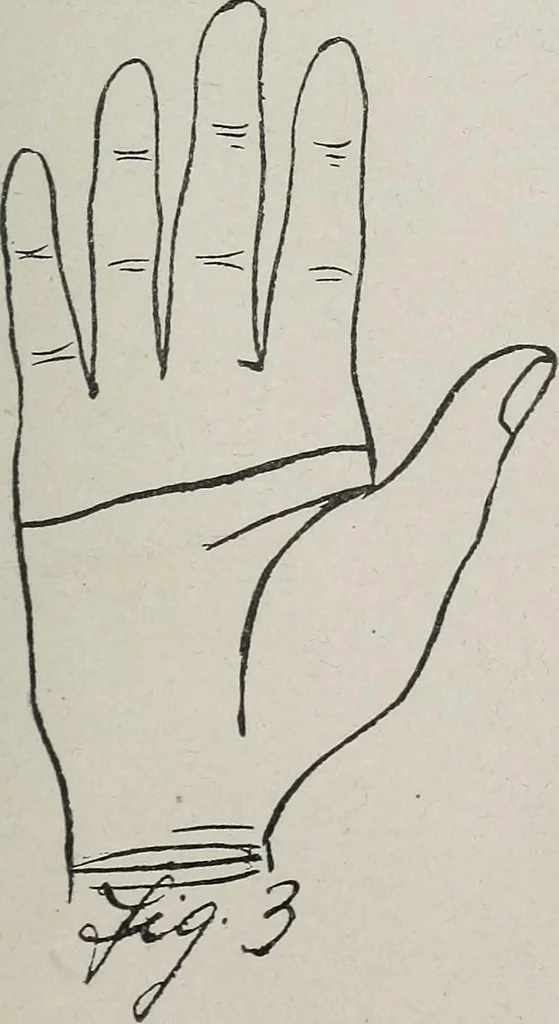 An illustration from Revelations of the hand. A scientific study of the shape and markings of the hand, as an index to character, disease, and tendencies, with explanatory illustrations, 1900, leaf 102