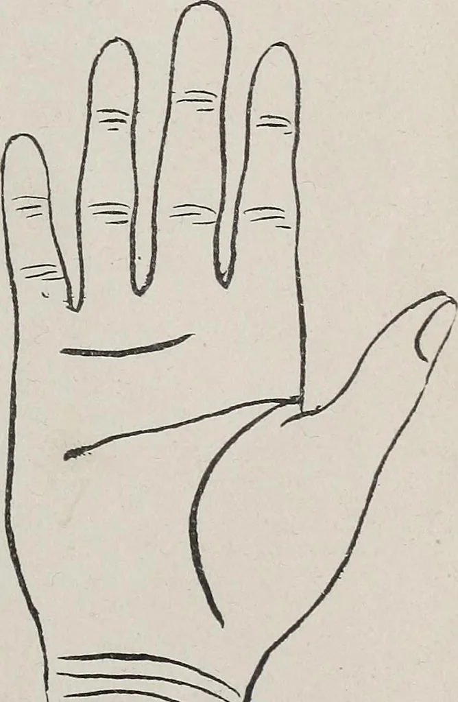 An illustration from Revelations of the hand. A scientific study of the shape and markings of the hand, as an index to character, disease, and tendencies, with explanatory illustrations, 1900, leaf 102