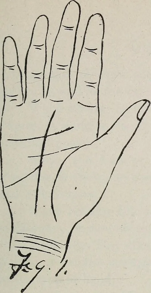 An illustration from Revelations of the hand. A scientific study of the shape and markings of the hand, as an index to character, disease, and tendencies, with explanatory illustrations, 1900, leaf 108