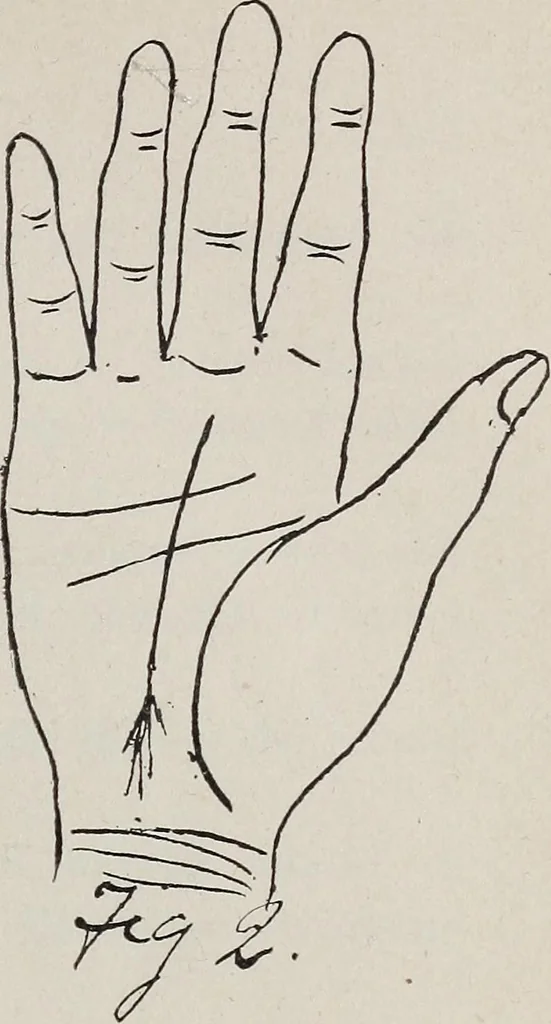 An illustration from Revelations of the hand. A scientific study of the shape and markings of the hand, as an index to character, disease, and tendencies, with explanatory illustrations, 1900, leaf 108