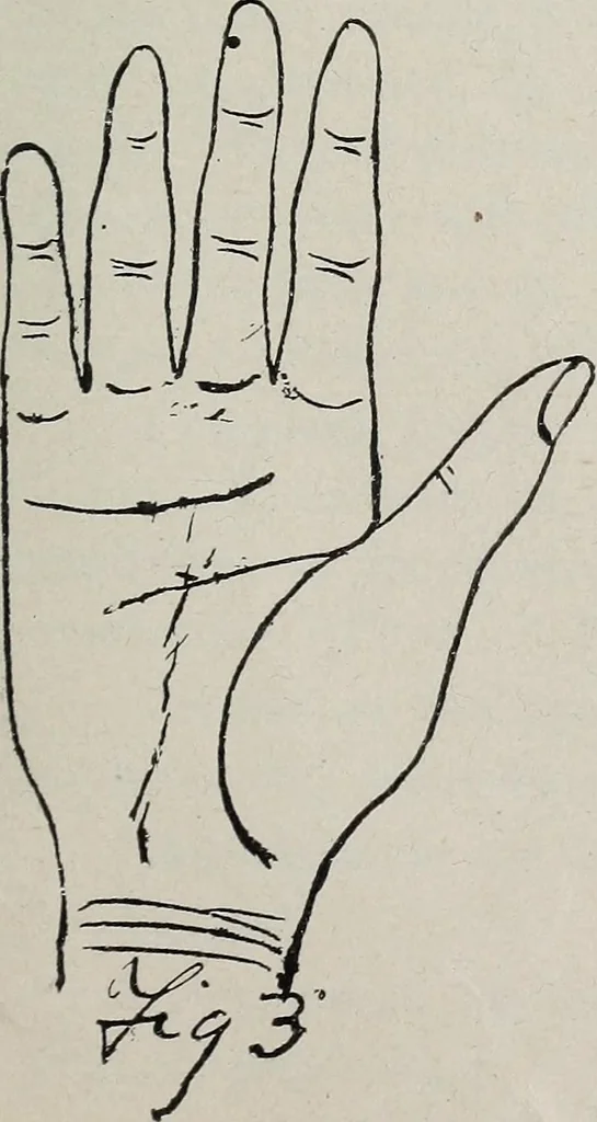 An illustration from Revelations of the hand. A scientific study of the shape and markings of the hand, as an index to character, disease, and tendencies, with explanatory illustrations, 1900, leaf 108