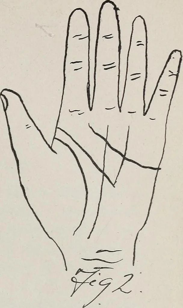 An illustration from Revelations of the hand. A scientific study of the shape and markings of the hand, as an index to character, disease, and tendencies, with explanatory illustrations, 1900, leaf 114
