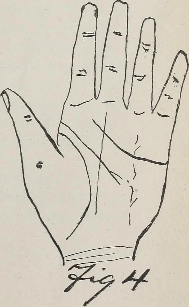 An illustration from Revelations of the hand. A scientific study of the shape and markings of the hand, as an index to character, disease, and tendencies, with explanatory illustrations, 1900, leaf 114