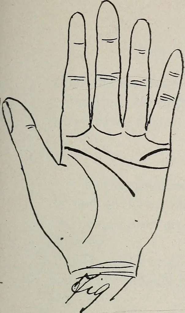 An illustration from Revelations of the hand. A scientific study of the shape and markings of the hand, as an index to character, disease, and tendencies, with explanatory illustrations, 1900, leaf 124