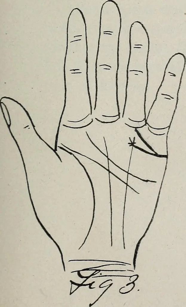 An illustration from Revelations of the hand. A scientific study of the shape and markings of the hand, as an index to character, disease, and tendencies, with explanatory illustrations, 1900, leaf 124