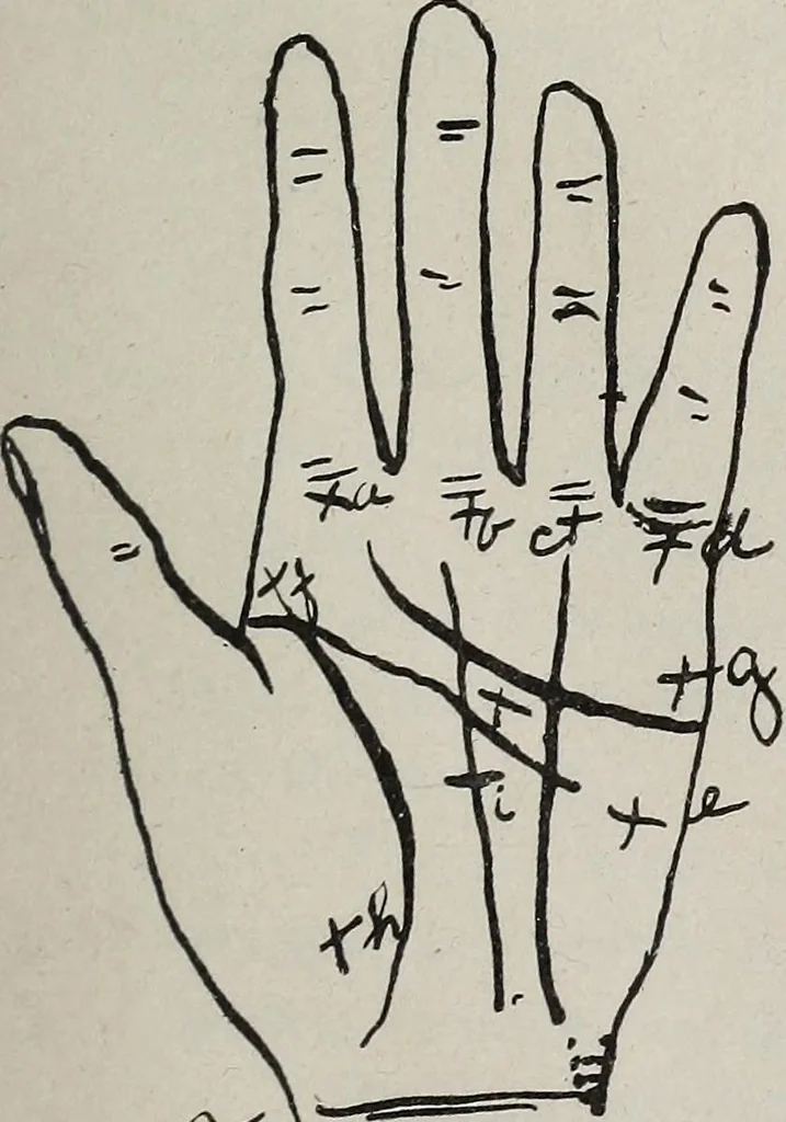 An illustration from Revelations of the hand. A scientific study of the shape and markings of the hand, as an index to character, disease, and tendencies, with explanatory illustrations, 1900, leaf 146
