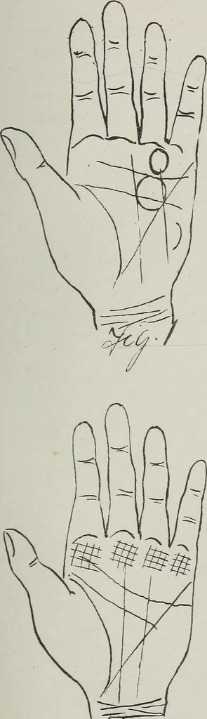 An illustration from Revelations of the hand. A scientific study of the shape and markings of the hand, as an index to character, disease, and tendencies, with explanatory illustrations, 1900, leaf 150