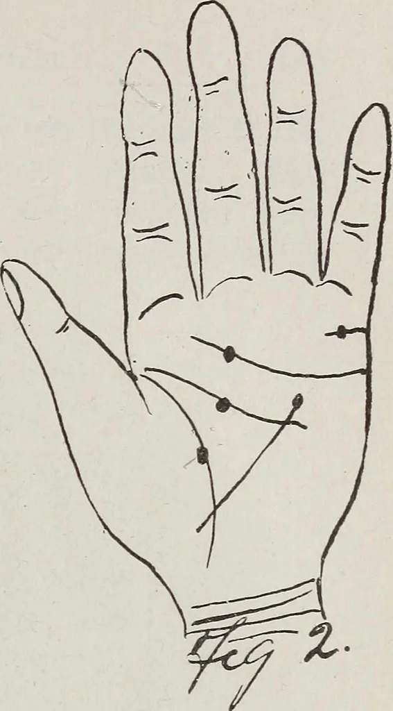 An illustration from Revelations of the hand. A scientific study of the shape and markings of the hand, as an index to character, disease, and tendencies, with explanatory illustrations, 1900, leaf 150
