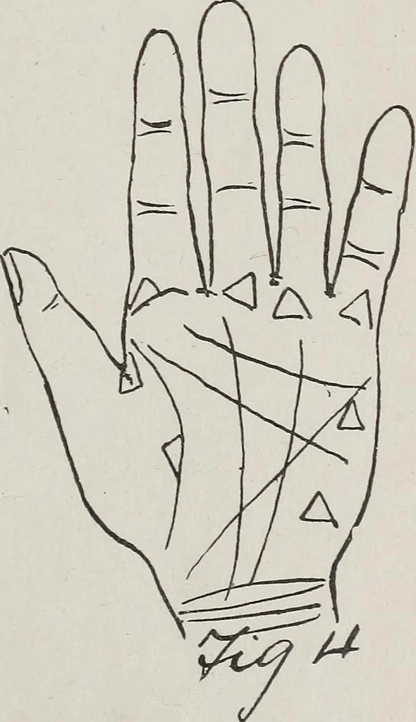 An illustration from Revelations of the hand. A scientific study of the shape and markings of the hand, as an index to character, disease, and tendencies, with explanatory illustrations, 1900, leaf 150