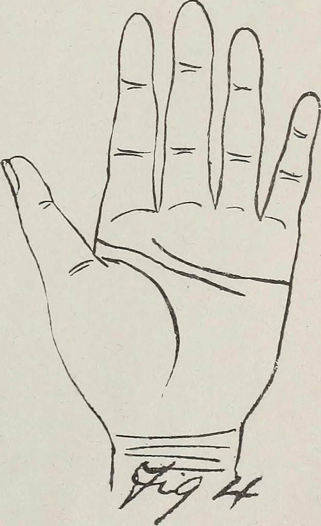 An illustration from Revelations of the hand. A scientific study of the shape and markings of the hand, as an index to character, disease, and tendencies, with explanatory illustrations, 1900, leaf 154