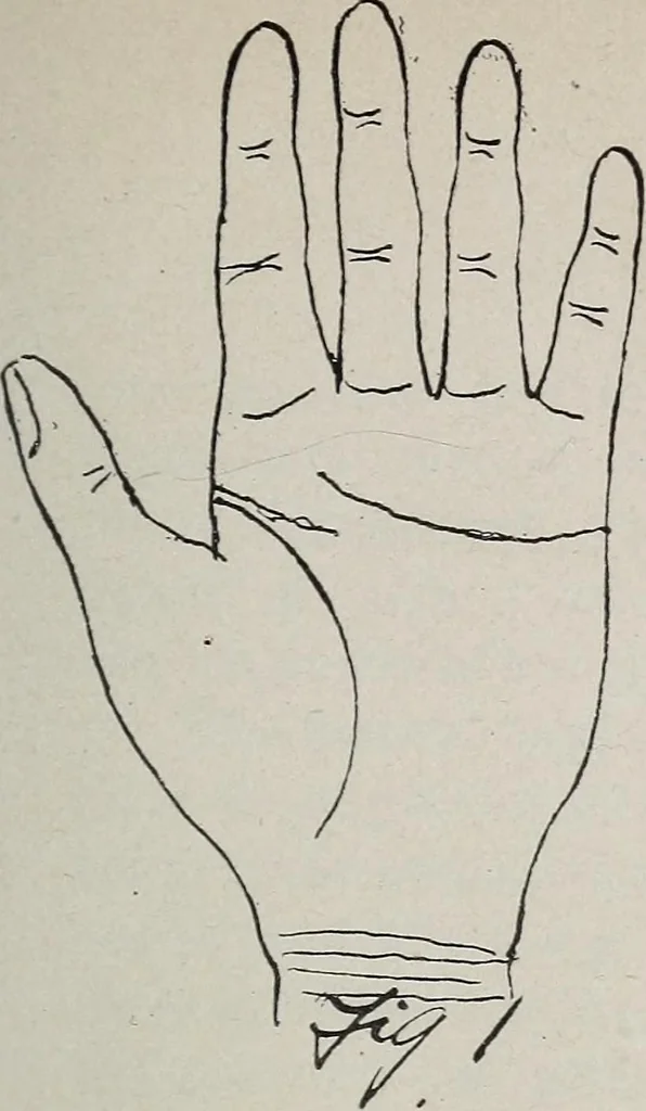 An illustration from Revelations of the hand. A scientific study of the shape and markings of the hand, as an index to character, disease, and tendencies, with explanatory illustrations, 1900, leaf 96