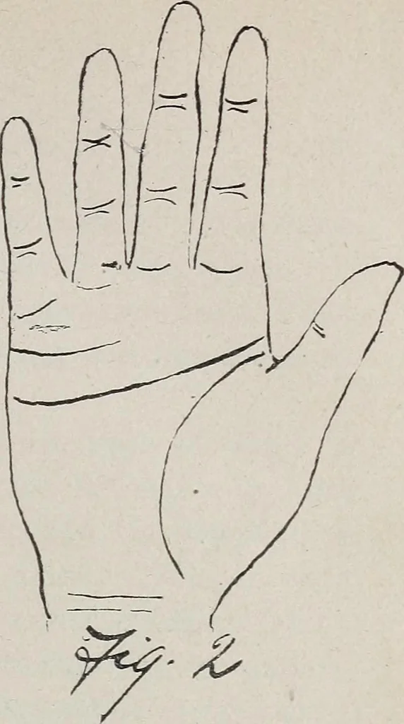 An illustration from Revelations of the hand. A scientific study of the shape and markings of the hand, as an index to character, disease, and tendencies, with explanatory illustrations, 1900, leaf 96