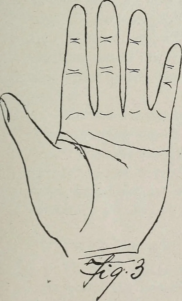 An illustration from Revelations of the hand. A scientific study of the shape and markings of the hand, as an index to character, disease, and tendencies, with explanatory illustrations, 1900, leaf 96