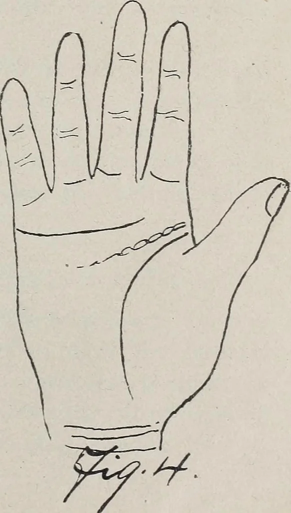 An illustration from Revelations of the hand. A scientific study of the shape and markings of the hand, as an index to character, disease, and tendencies, with explanatory illustrations, 1900, leaf 96