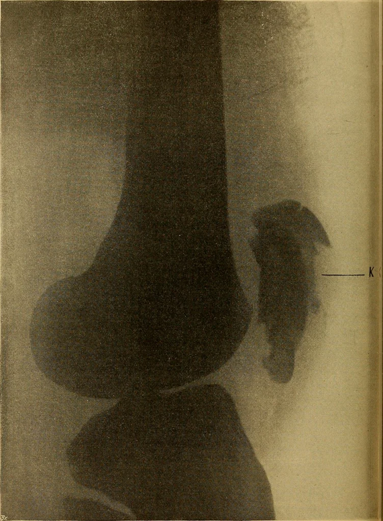 An illustration from Röntgenphotographie : Anleitung zu leicht auszuführenden Arbeiten mit statischer und galvanischer Elektrizität unter besonderer Berücksichtigung der Influenz-Elektrisiermaschine, 1908, leaf 89