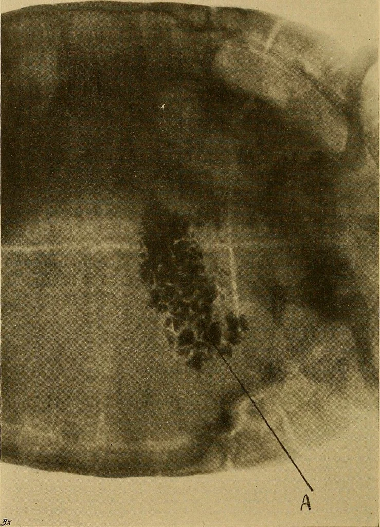 An illustration from Röntgenphotographie : Anleitung zu leicht auszuführenden Arbeiten mit statischer und galvanischer Elektrizität unter besonderer Berücksichtigung der Influenz-Elektrisiermaschine, 1908, leaf 95