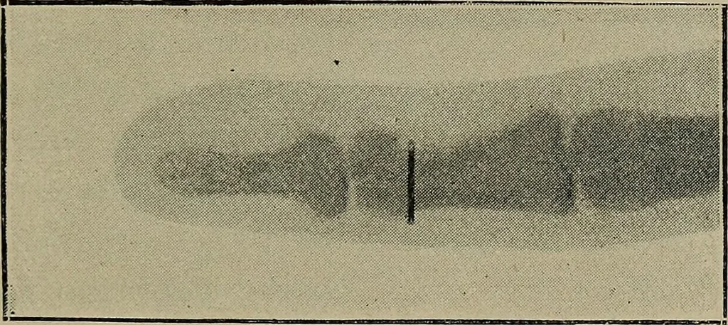 An illustration from The Röntgen rays in medical work, 1899, leaf 102