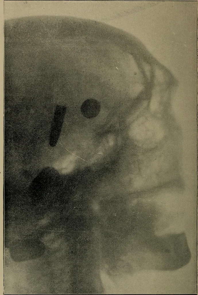 An illustration from The Röntgen rays in medical work, 1899, leaf 111