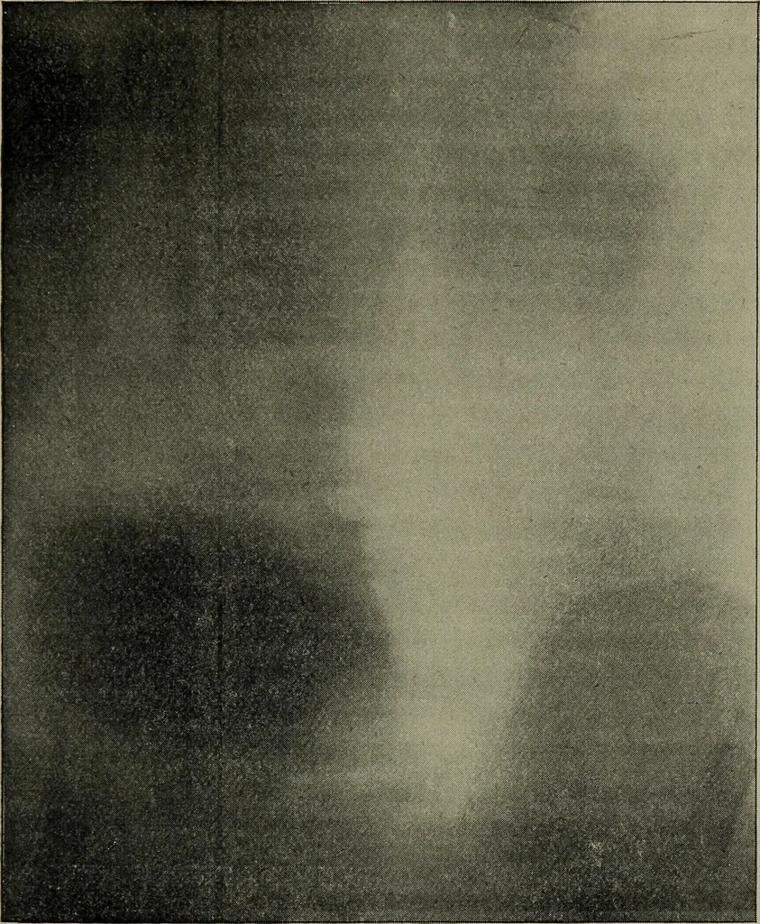 An illustration from The Röntgen rays in medical work, 1899, leaf 132