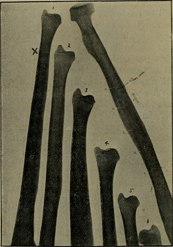 An illustration from The Röntgen rays in medical work, 1899, leaf 153