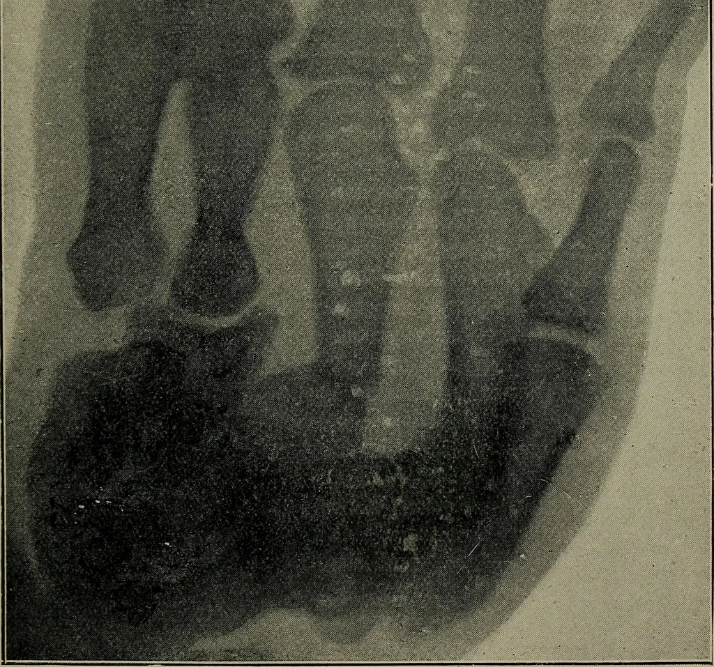 An illustration from The Röntgen rays in medical work, 1899, leaf 154