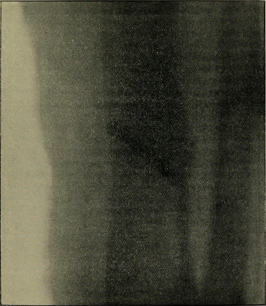 An illustration from The Röntgen rays in medical work, 1899, leaf 158