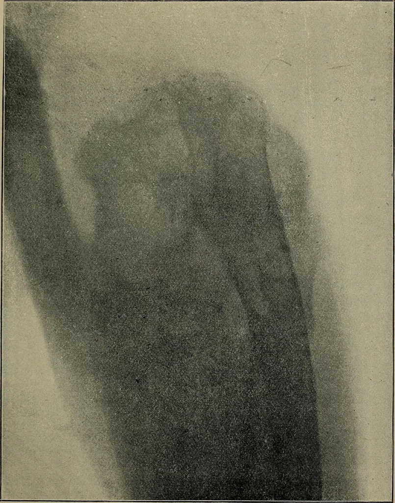 An illustration from The Röntgen rays in medical work, 1899, leaf 162