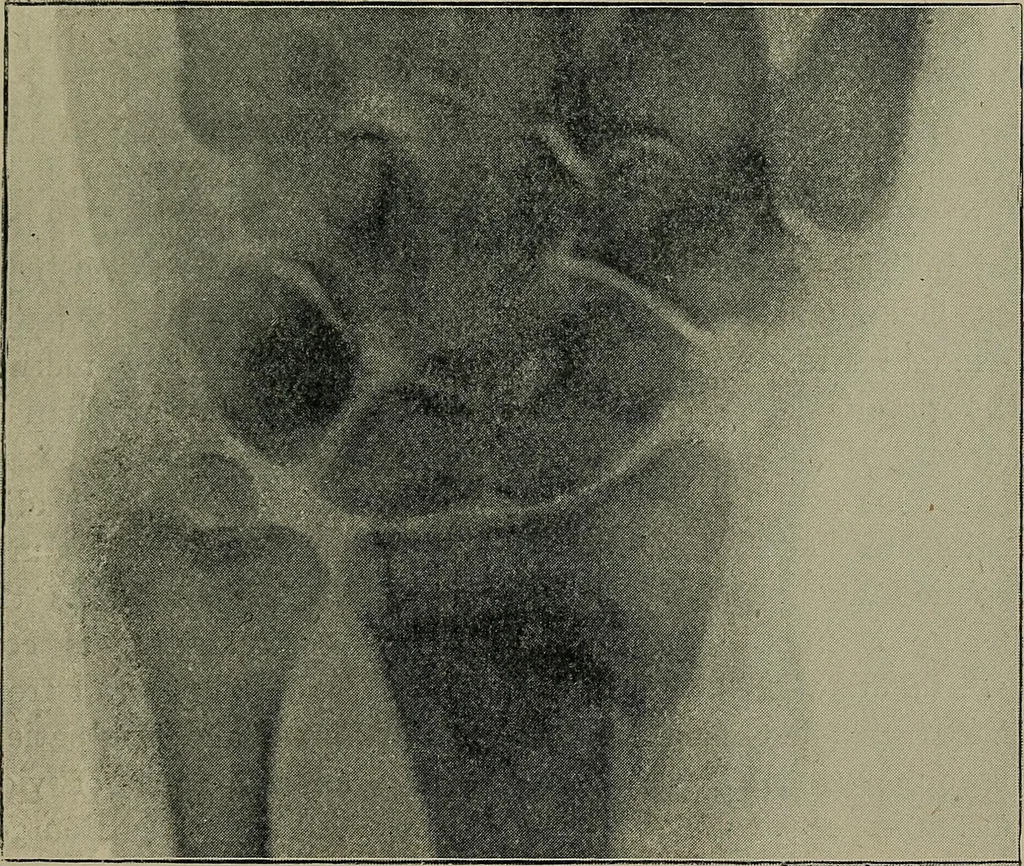 An illustration from The Röntgen rays in medical work, 1899, leaf 166