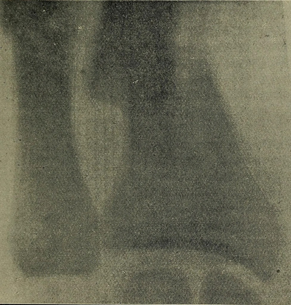 An illustration from The Röntgen rays in medical work, 1899, leaf 168