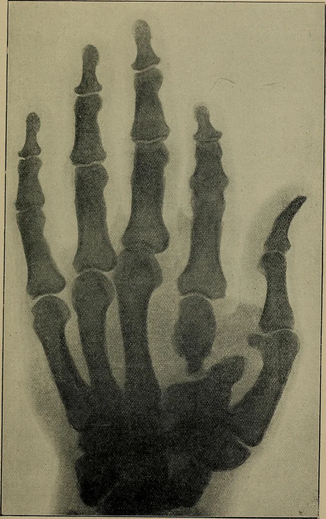 An illustration from The Röntgen rays in medical work, 1899, leaf 172