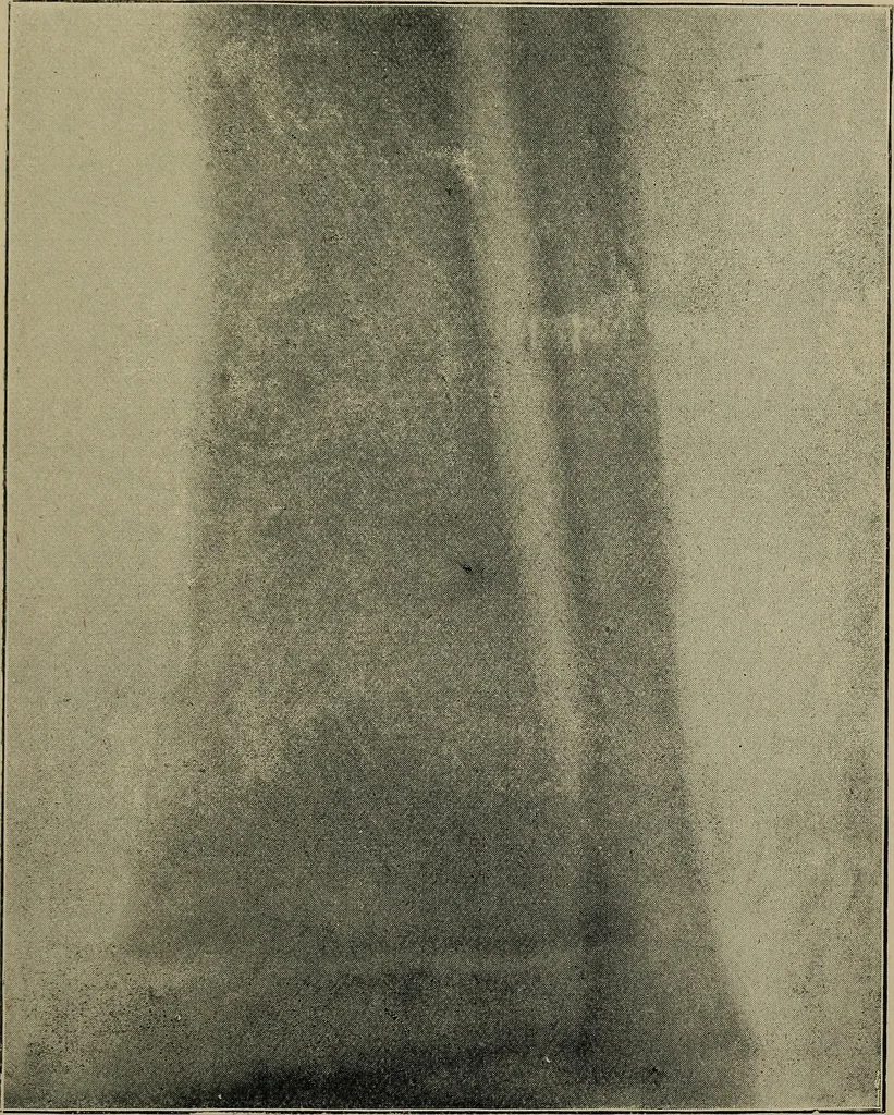 An illustration from The Röntgen rays in medical work, 1899, leaf 176