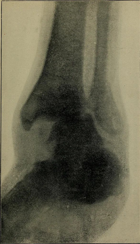 An illustration from The Röntgen rays in medical work, 1899, leaf 182
