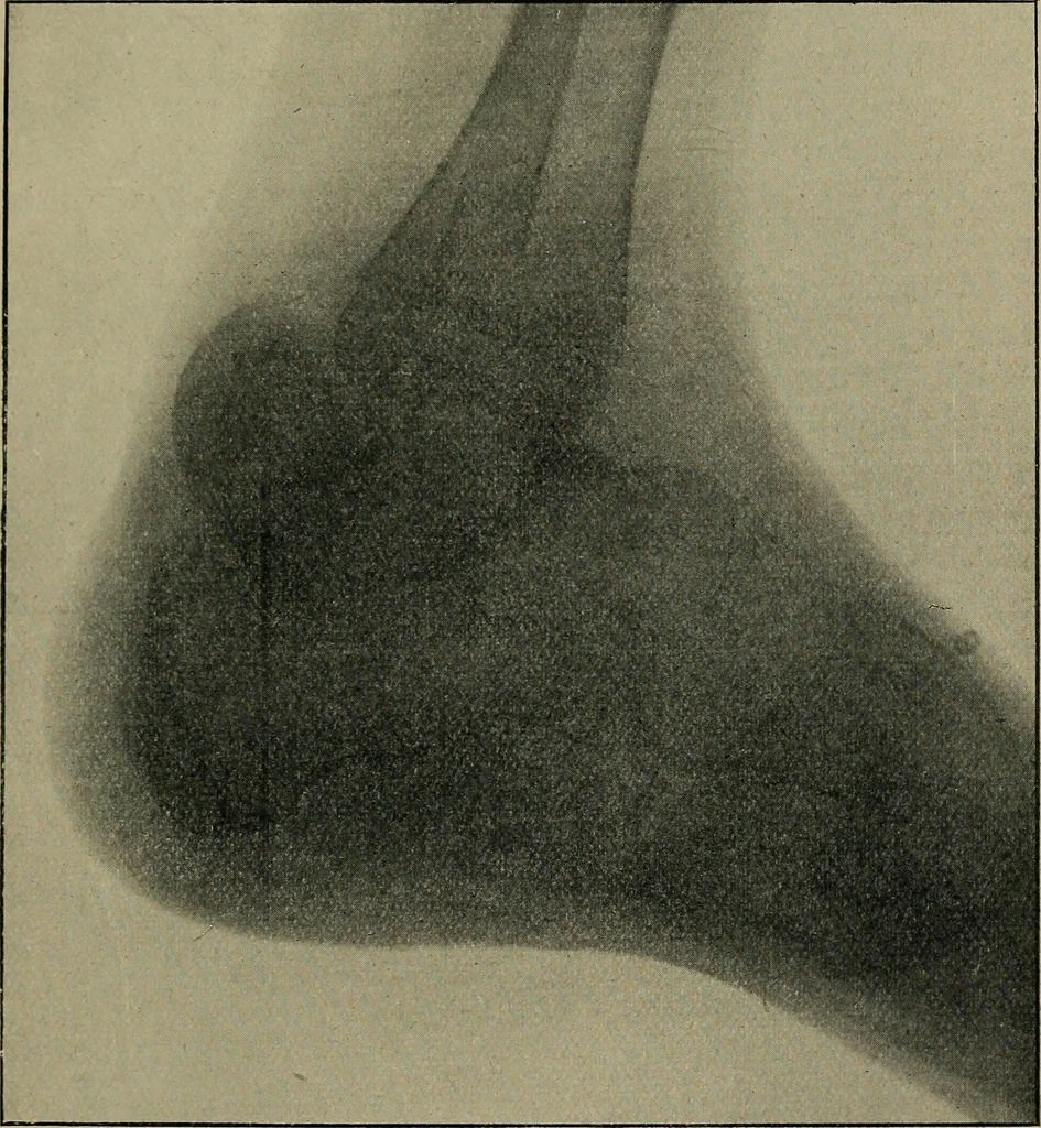 An illustration from The Röntgen rays in medical work, 1899, leaf 184