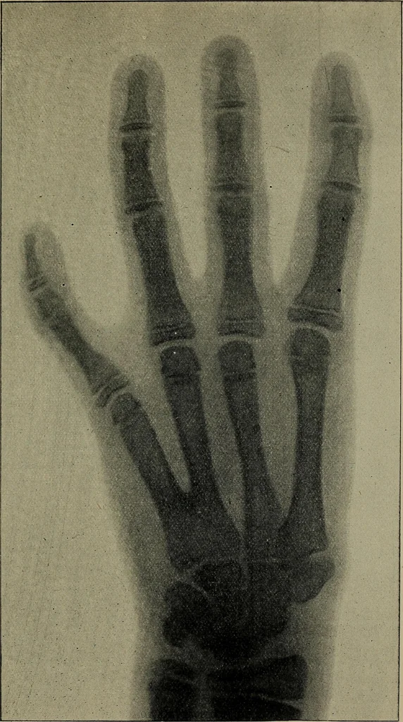 An illustration from The Röntgen rays in medical work, 1899, leaf 204
