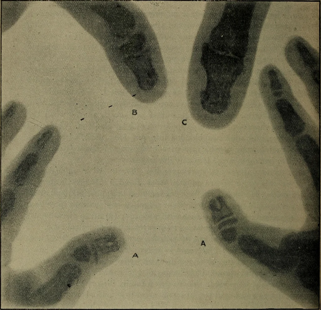 An illustration from The Röntgen rays in medical work, 1899, leaf 207