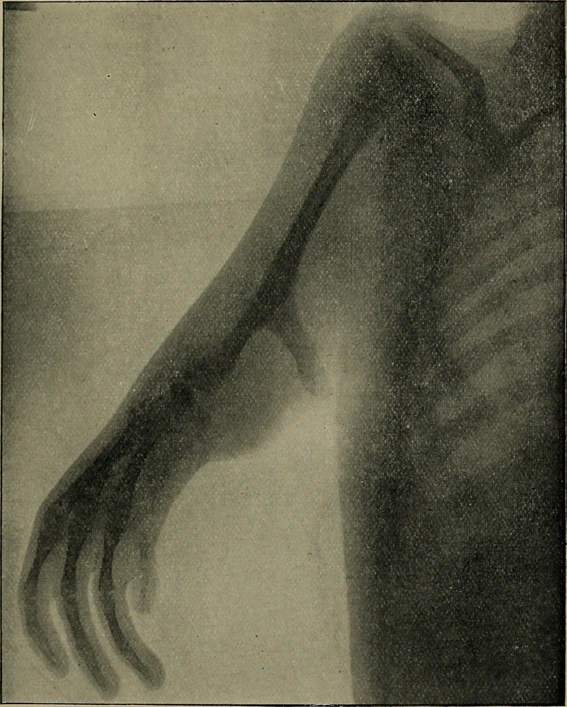 An illustration from The Röntgen rays in medical work, 1899, leaf 208