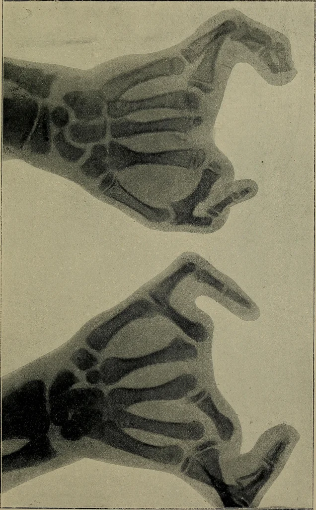 An illustration from The Röntgen rays in medical work, 1899, leaf 210