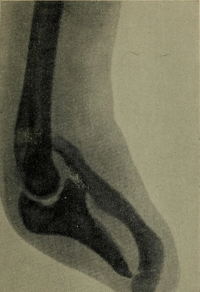 An illustration from The Röntgen rays in medical work, 1899, leaf 216