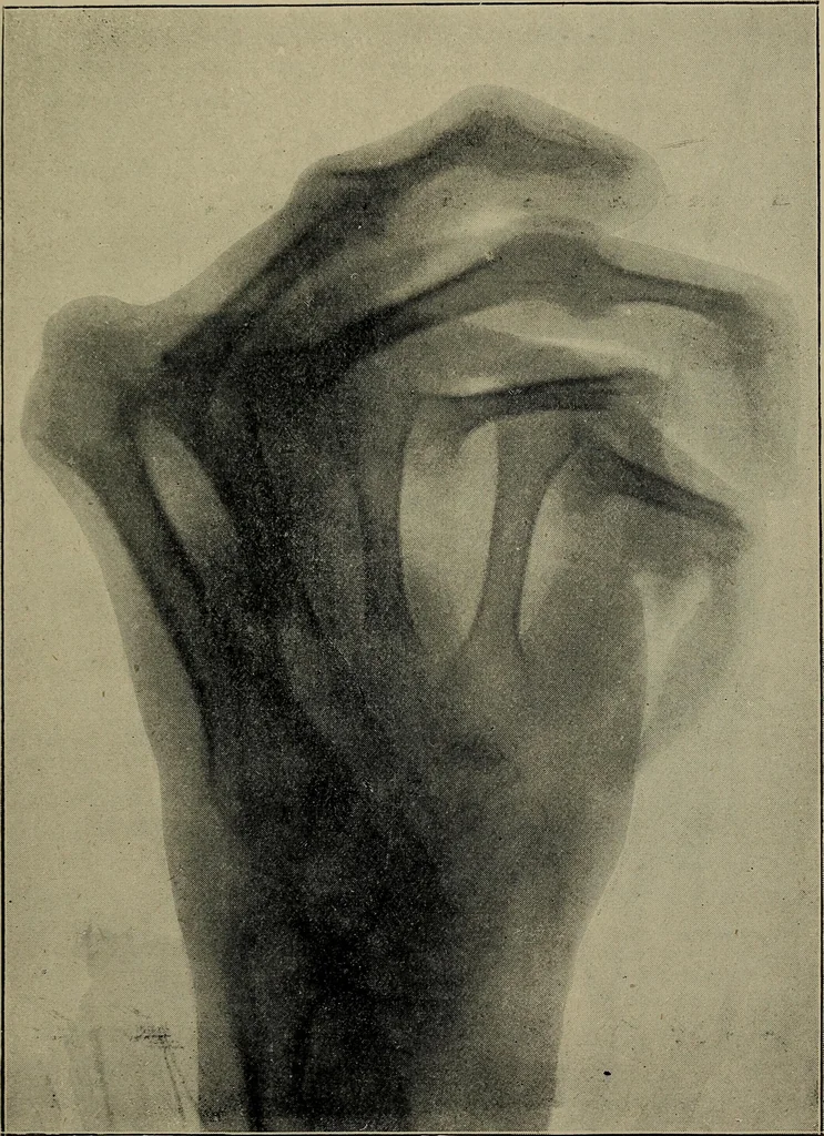 An illustration from The Röntgen rays in medical work, 1899, leaf 224