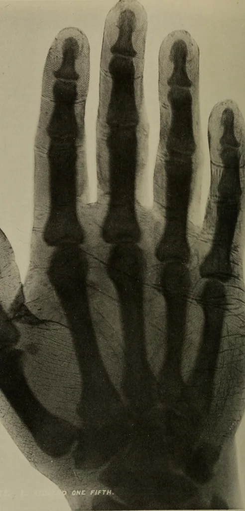 An illustration from The Röntgen rays in medical work, 1899, leaf 7