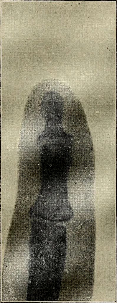 An illustration from The Röntgen rays in medical work, 1899, leaf 92