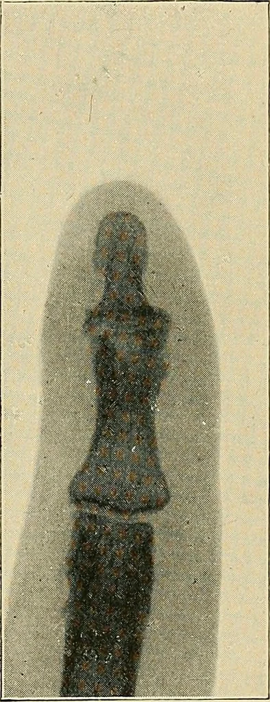 An illustration from The Röntgen rays in medical work, 1907, leaf 148