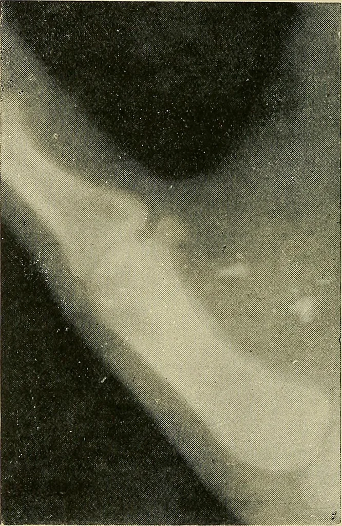 An illustration from The Röntgen rays in medical work, 1907, leaf 159