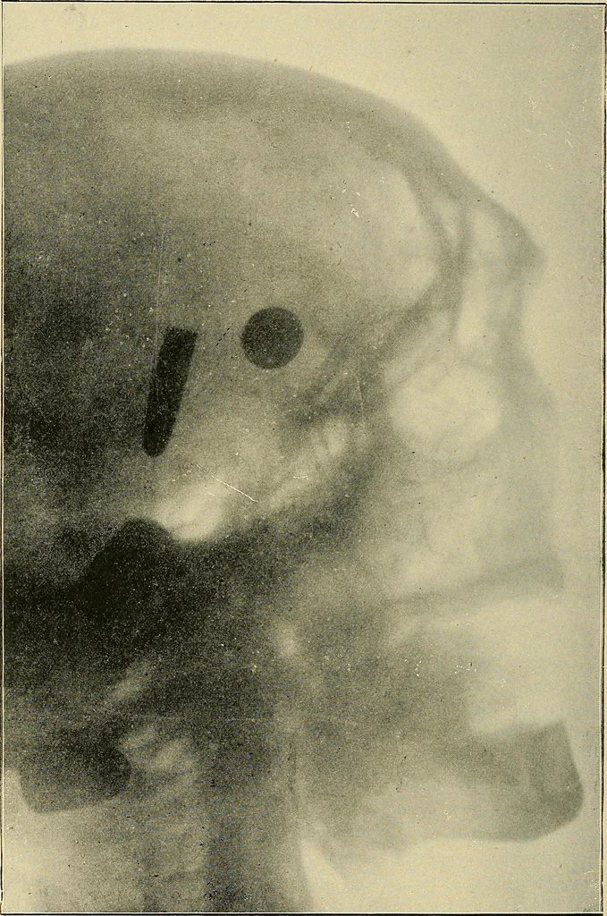 An illustration from The Röntgen rays in medical work, 1907, leaf 165