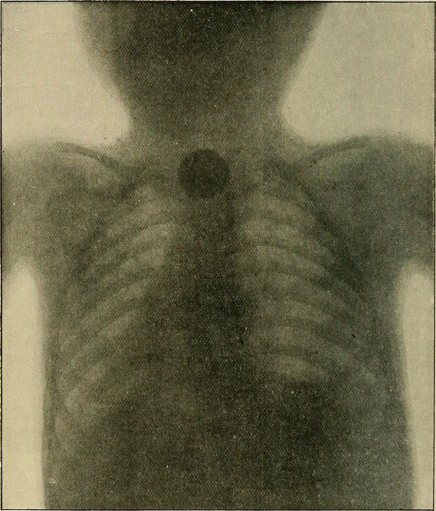 An illustration from The Röntgen rays in medical work, 1907, leaf 179