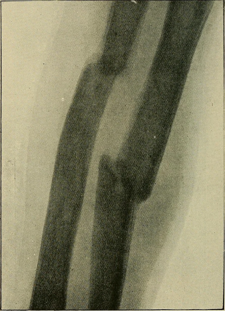 An illustration from The Röntgen rays in medical work, 1907, leaf 211