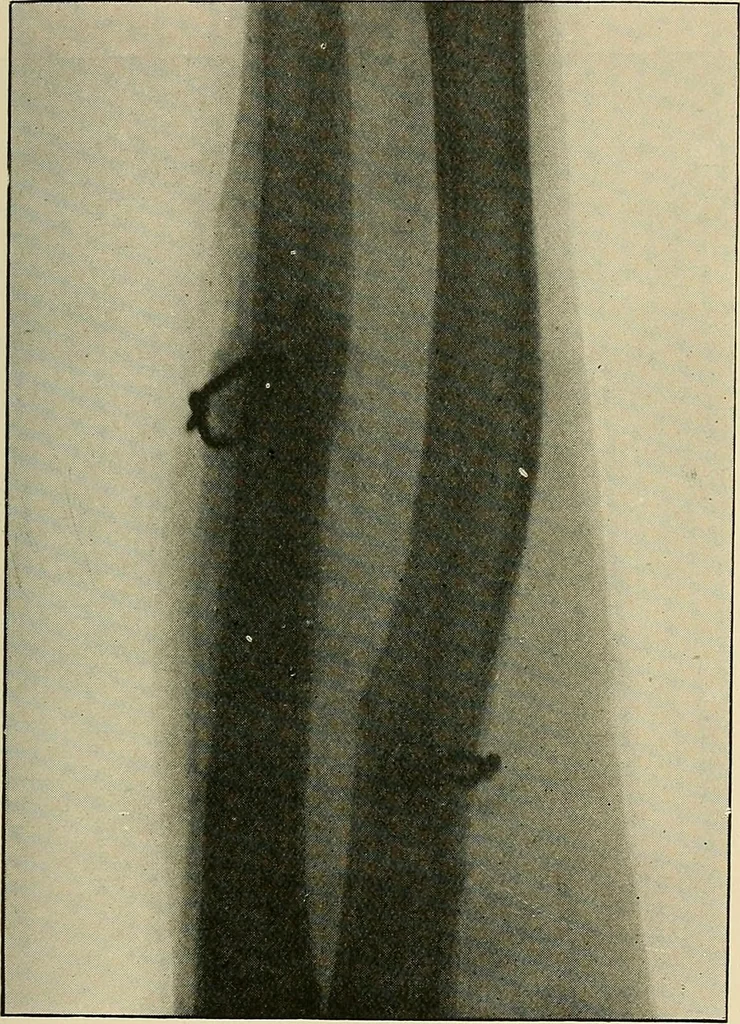 An illustration from The Röntgen rays in medical work, 1907, leaf 212