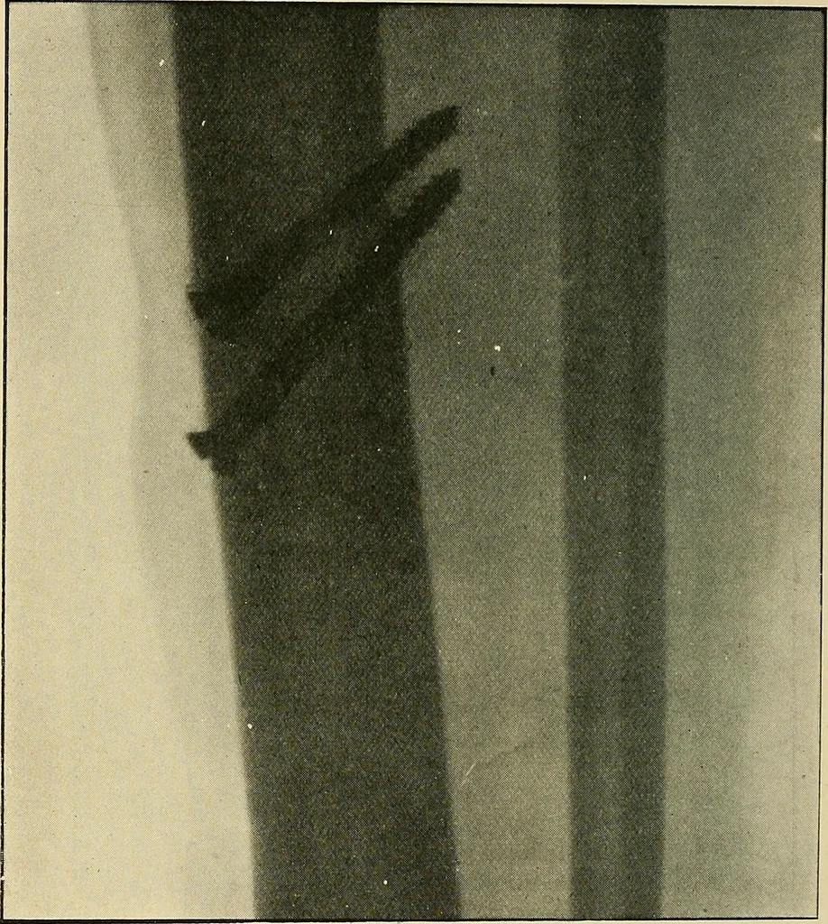An illustration from The Röntgen rays in medical work, 1907, leaf 213