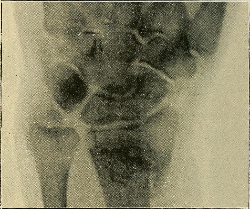 An illustration from The Röntgen rays in medical work, 1907, leaf 221